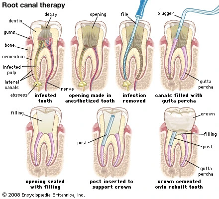 Step-by-step guide to root canal therapy by dentist around Clementi