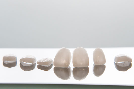 Ceramic Veneers Ceramic Veneers