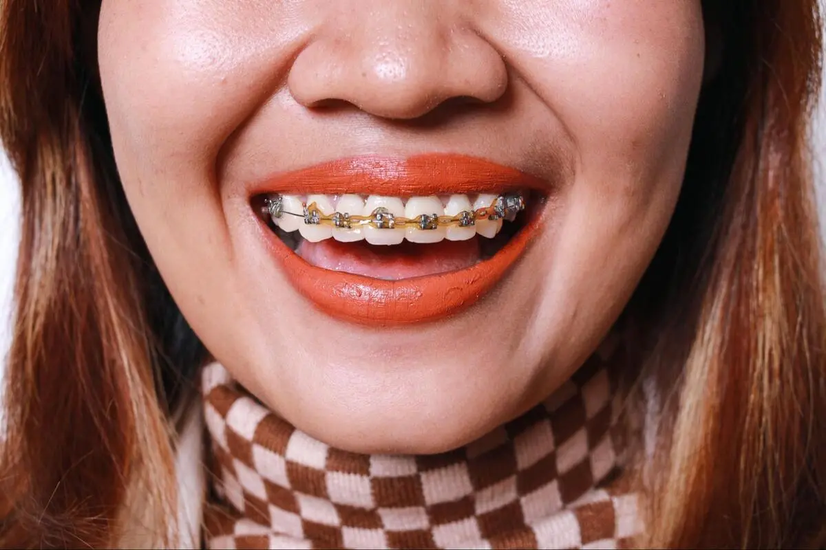 Close-up of a patient's smile showing metal dental braces during orthodontic treatment