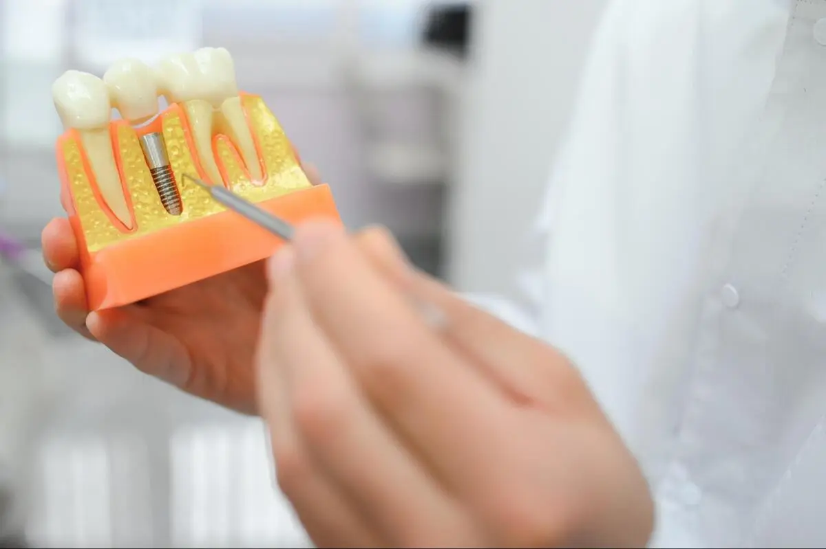 A hand holding a cross-section dental model showing how an implant screw integrates into the red gum and bone tissue.