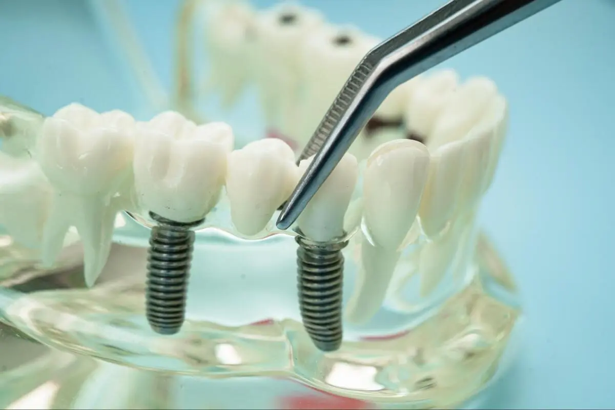 A dental tool pointing to a titanium dental implant post on a clear jaw model.