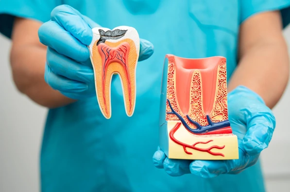 Dental model showing the structure of a chipped tooth