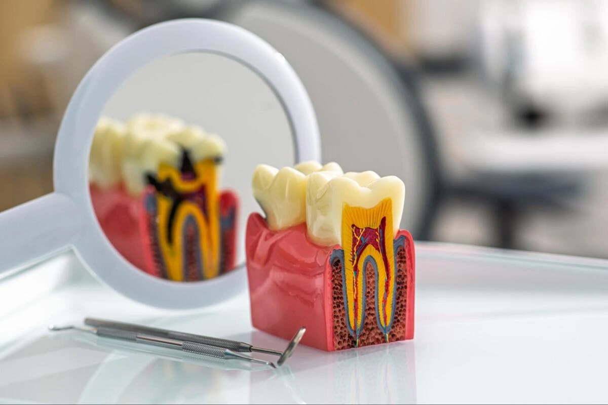 Cross-section dental model showing healthy and decayed tooth anatomy, including root canal structure, displayed on a clinical tray with dental instruments