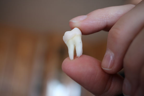 Wisdom Tooth Extraction in Singapore Wisdom Tooth Extraction in Singapore