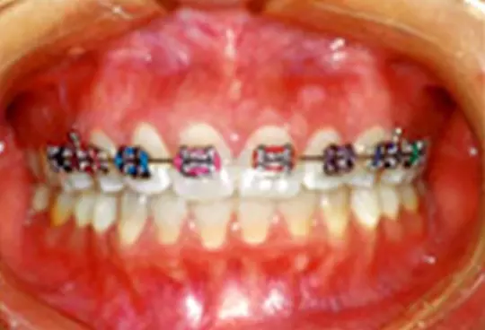 Orthodontic Treatments at Clementi Dentist - See Results!